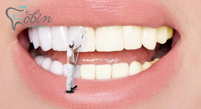 بیلچینگ دندان به چند روش قابل انجام است.